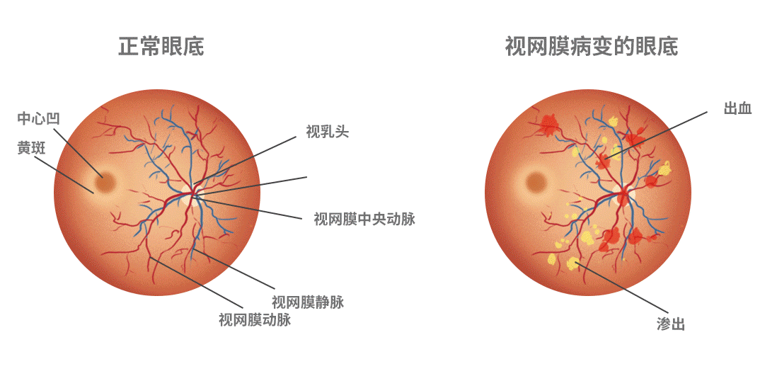 视网膜静脉阻塞.png