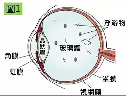 飞蚊症.webp.jpg